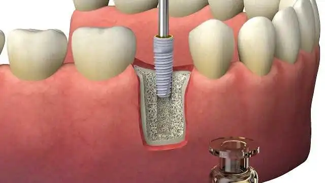 المرحلة الثانية من زراعة الأسنان في ايران بمدن شيراز وطهران