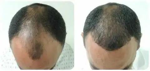 hair Transplant in iran
