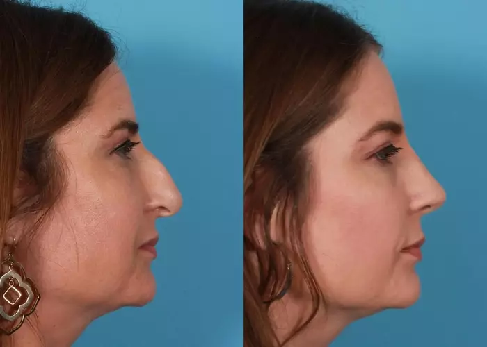rhinoplasty before and after surgery