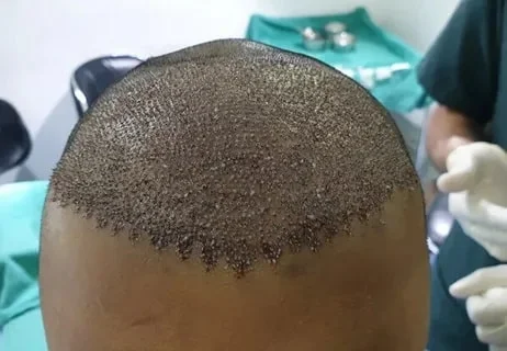 hair Transplant in Iran