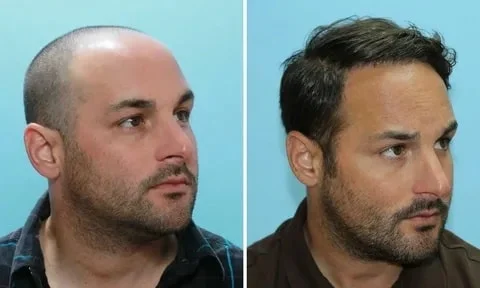 Hair transplant in Shiraz