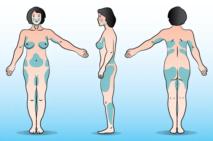 Liposuction treatmentareas in Iran