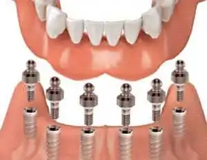 implants vs dentures